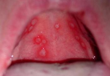 Аллергия на гексорал отек