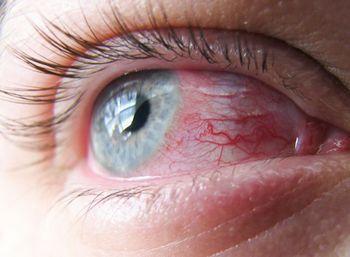 Капли от синдрома сухого глаза оксиал