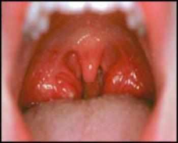 От стрепсилса болят зубы