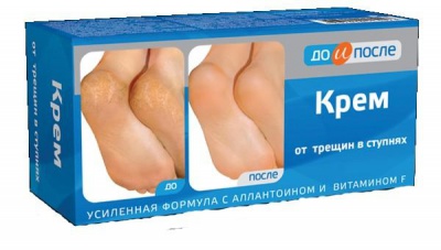 До и после Крем для ног от трещин в ступнях 50 мл