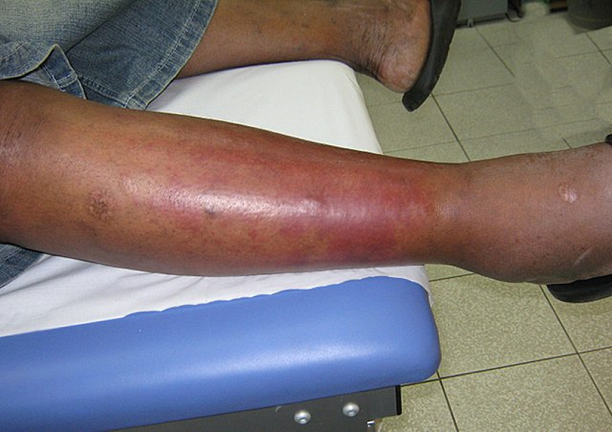 Болезнь рожа на ноге – фото, симптомы и лечение