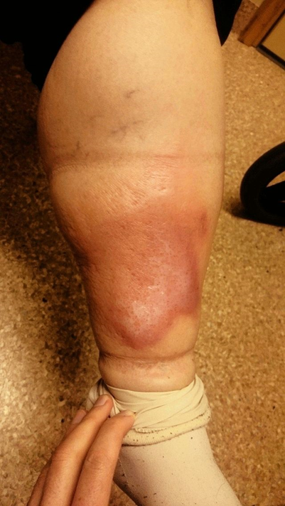 Болезнь рожа на ноге – фото, симптомы и лечение