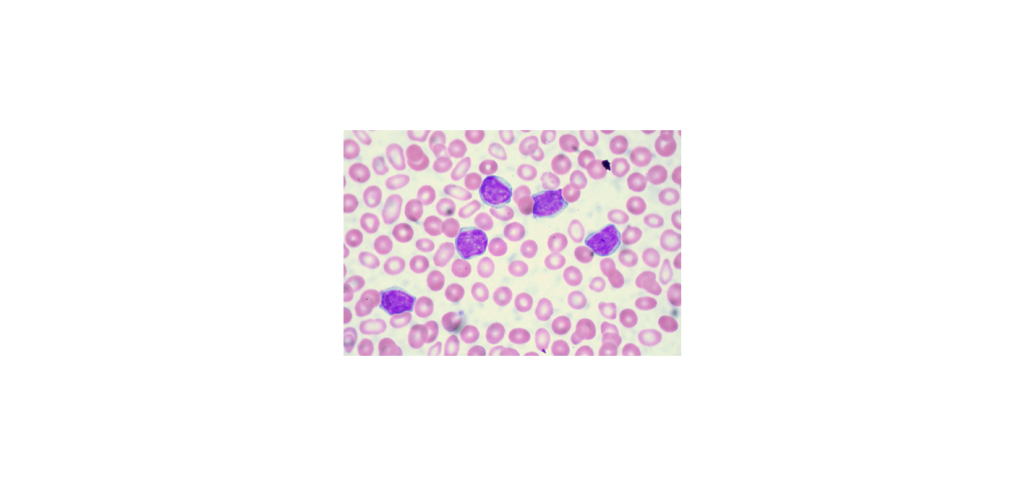 Анализ крови на лимфоциты