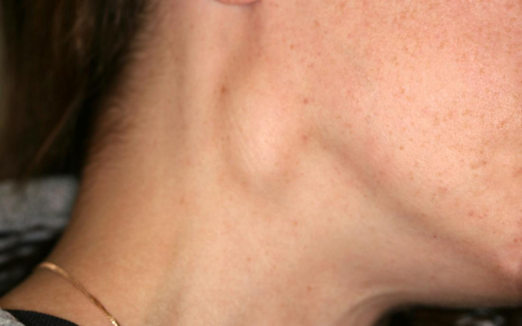 Почему болят лимфоузлы на шее: причины и лечение