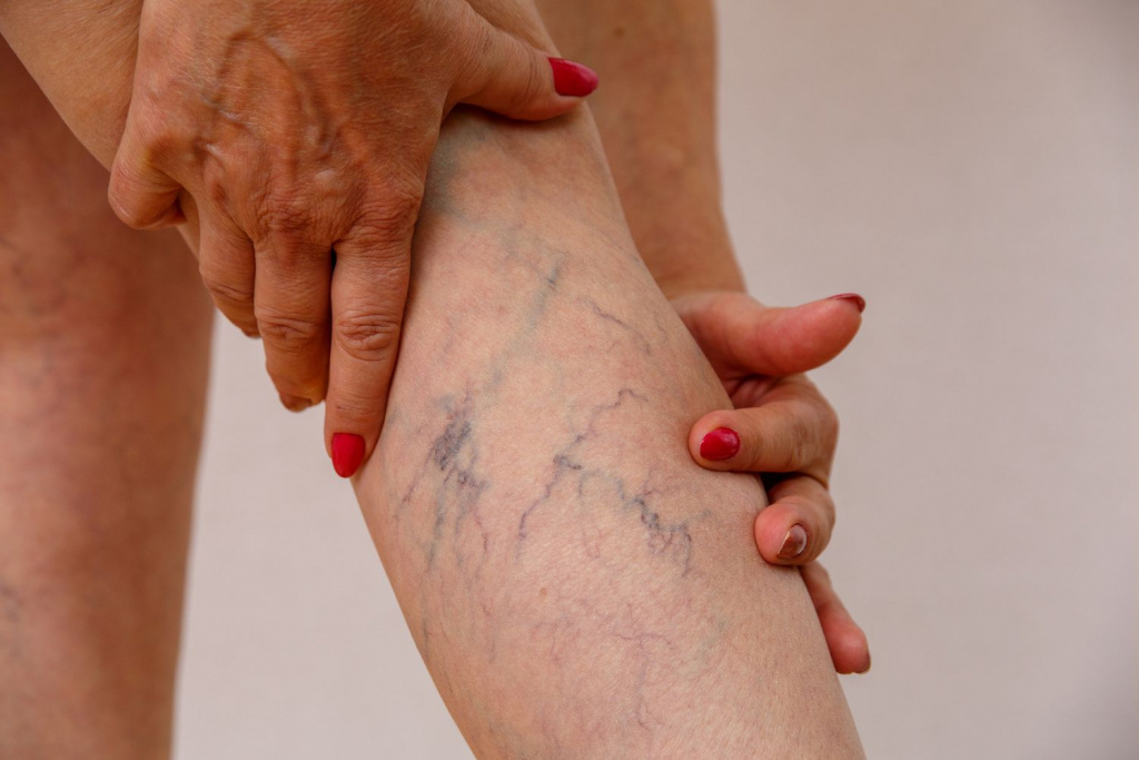 Варикоз на ногах - симптомы, диагностика, лечение