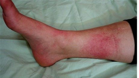 Как лечить рожистое воспаление ноги в домашних условиях