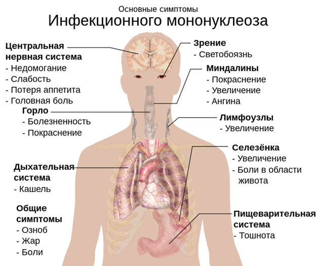 Инфекционный мононуклеоз:симптомы, лечение, диагностика, классификация