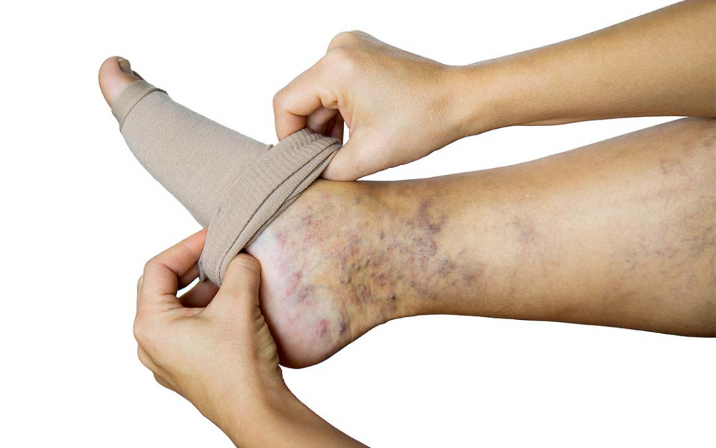 Лечение варикоза ног в домашних условиях: 3 главных метода