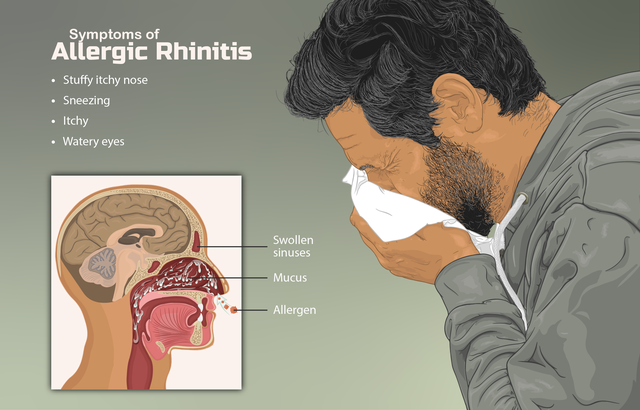 Симптомы аллергического ринита 