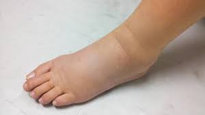 Отеки ног – это симптом с выраженным увеличением межтканевой жидкости в  нижних конечностях