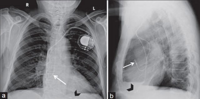 640px-X-ray_of_pacemaker_with_right_atrial_and_ventricular_lead.jpg