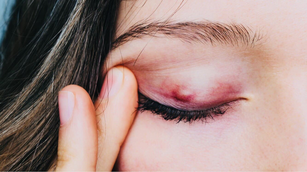 Ячмень на глазу - симптомы, причины и лечение